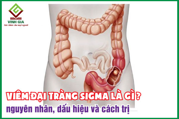 Viêm đại tràng sigma là gì? Triệu chứng và cách cải thiện