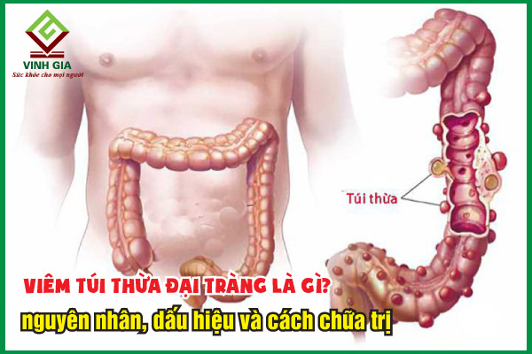 Viêm túi thừa đại tràng là gì? Triệu chứng và cách cải thiện