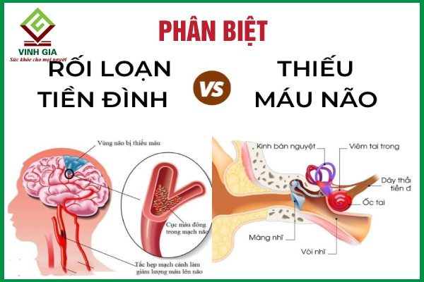 Cách phân biệt rối loạn tiền đình và thiếu máu não