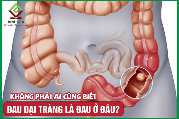 Đau đại tràng là đau ở đâu? Nguy hiểm như thế nào?