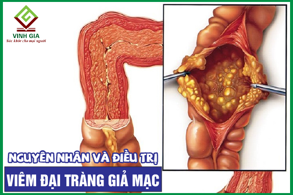 Viêm đại tràng giả mạc: Nguyên nhân, chẩn đoán và cải thiện