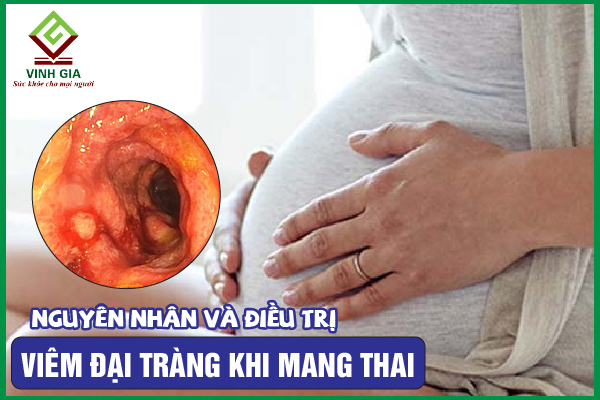 Viêm đại tràng khi mang thai: Làm gì để thai nhi khỏe mạnh?