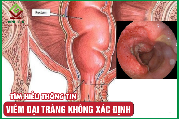 Viêm đại tràng không xác định: Nguyên nhân và cách cải thiện