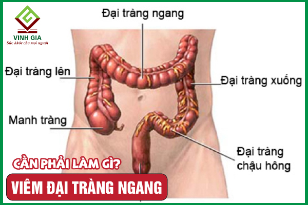 Viêm đại tràng ngang: Nguyên nhân, triệu chứng và cải thiện
