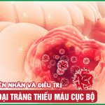 Viêm đại tràng thiếu máu cục bộ: Nguyên nhân và biện pháp