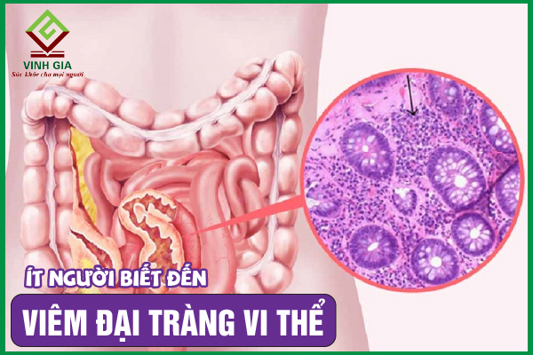 Viêm đại tràng vi thể: Nguyên nhân, chẩn đoán và cải thiện