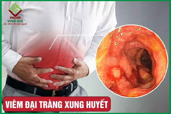 Viêm đại tràng xung huyết: Nguyên nhân, dấu hiệu và cải thiện