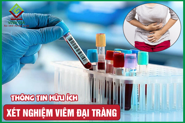 Các xét nghiệm viêm đại tràng cần phải có khi điều trị