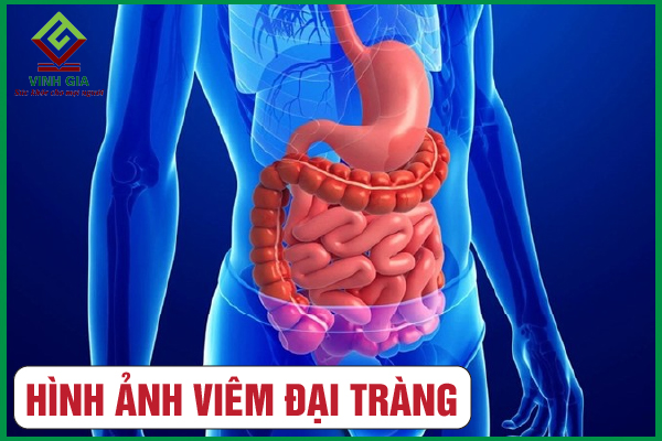 [CẨM NANG] Tổng hợp chi tiết các hình ảnh viêm đại tràng