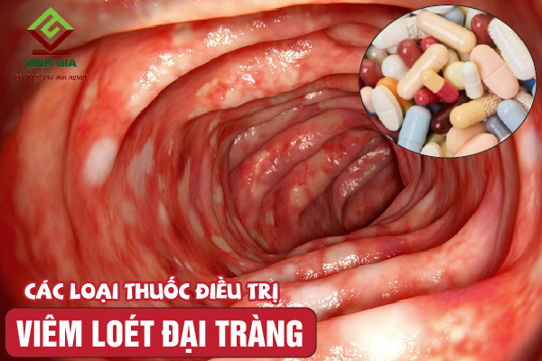 Những điều cần biết về các loại thuốc điều trị viêm loét đại tràng Những điều cần biết về các loại thuốc điều trị viêm loét đại tràng
