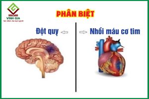 Phân biệt đột quỵ và nhồi máu cơ tim