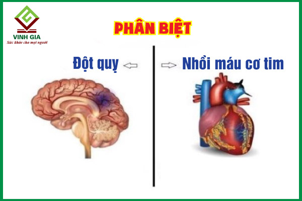 Phân biệt đột quỵ và nhồi máu cơ tim: định nghĩa, chẩn đoán và điều trị