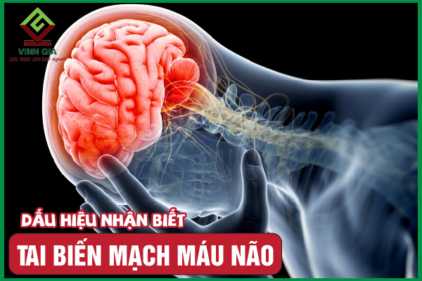 10 dấu hiệu tai biến mạch máu não mà bạn cần phải biết