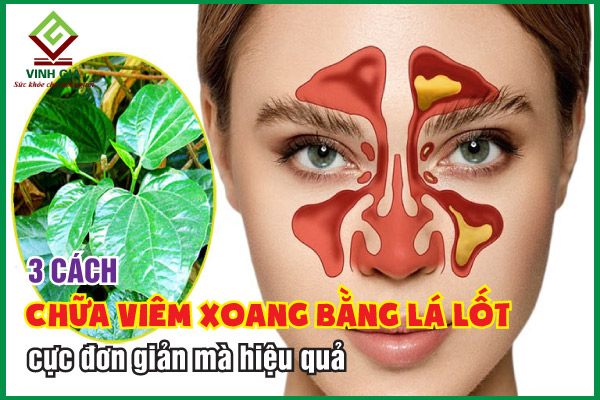 3 cách chữa viêm xoang bằng lá lốt hiệu quả dễ áp dụng