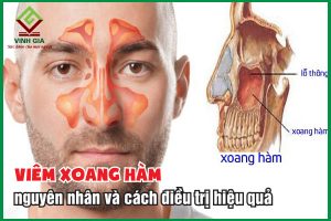 Bệnh viêm xoang hàm: Nguyên nhân và cách điều trị đúng cách