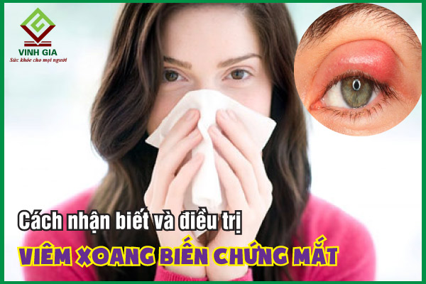 Viêm xoang biến chứng mắt: Cách nhận biết và điều trị hiệu quả