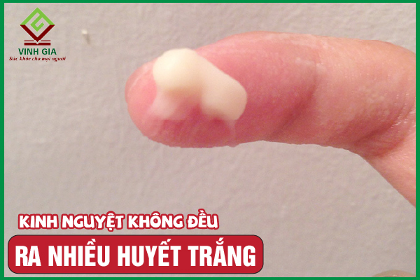 Kinh nguyệt không đều và ra nhiều huyết trắng là bệnh gì?