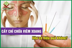 Phương pháp cấy chỉ chữa viêm xoang liệu có hiệu quả không?