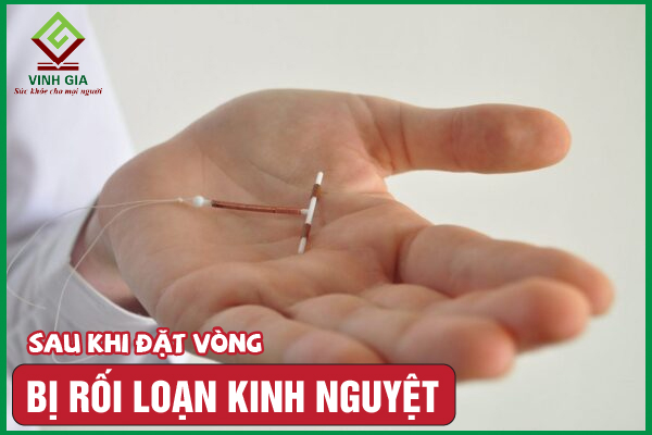 Rối loạn kinh nguyệt sau khi đặt vòng tránh thai do đâu?