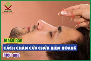 Tìm hiểu cách châm cứu chữa viêm xoang hiệu quả