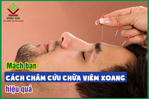 Tìm hiểu cách châm cứu chữa viêm xoang hiệu quả