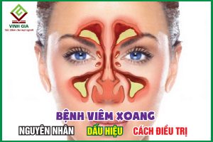 Viêm xoang: Nguyên nhân, triệu chứng, cách trị và phòng ngừa