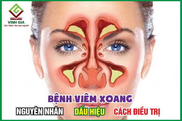 Viêm xoang: Nguyên nhân, triệu chứng, cách trị và phòng ngừa