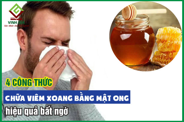 4 công thức chữa viêm xoang bằng mật ong hiệu quả bất ngờ