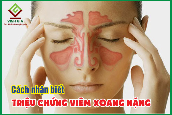 Cách nhận biết các triệu chứng viêm xoang nặng
