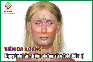 Viêm đa xoang: Nguyên nhân, triệu chứng và cách điều trị