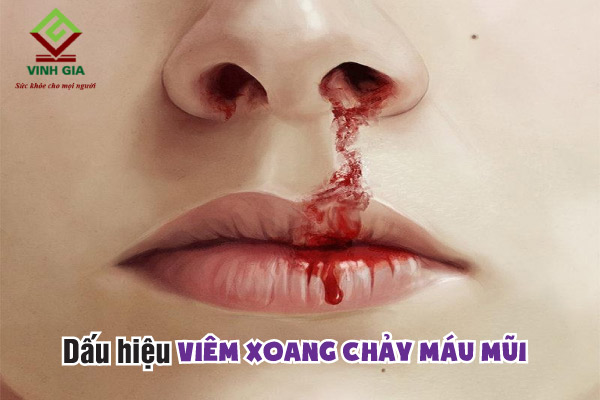 Dấu hiệu dễ nhận biết viêm xoang mũi chảy máu