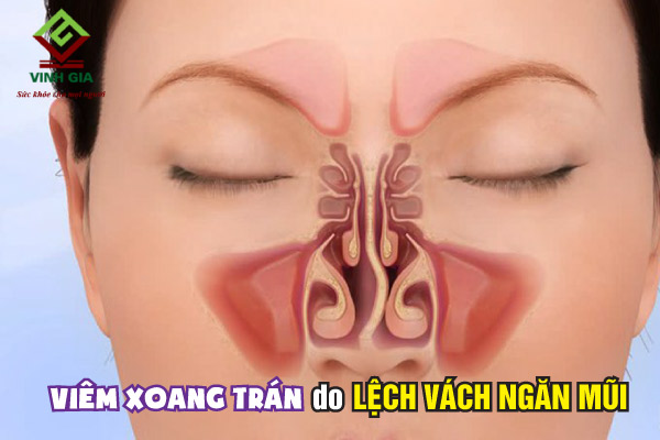 Lệch vách ngăn mũi cũng có thể gây viêm xoang trán