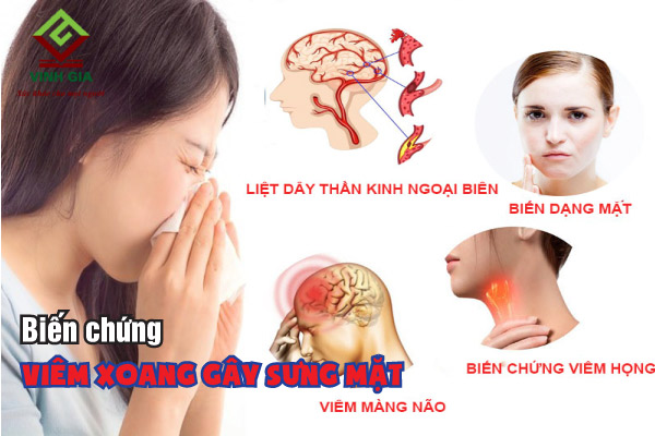 Những biến chứng thường gặp của bệnh viêm xoang gây sưng mặt