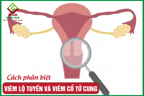 Viêm lộ tuyến và viêm cổ tử cung khác nhau như thế nào?
