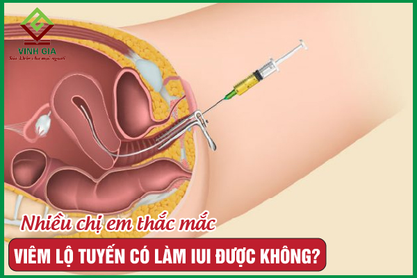 Chị em bị viêm lộ tuyến có làm iui được không?