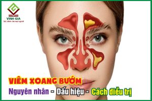 Viêm xoang bướm là gì? Nguyên nhân, triệu chứng và cách chữa