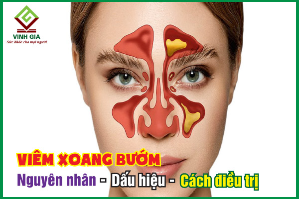 Viêm xoang bướm là gì? Nguyên nhân, triệu chứng và cách chữa