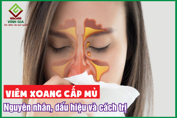 Những điều cần biết về viêm xoang cấp mủ 