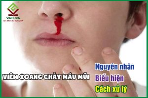 Viêm xoang chảy máu mũi: Nguyên nhân, biểu hiện và cách xử lý
