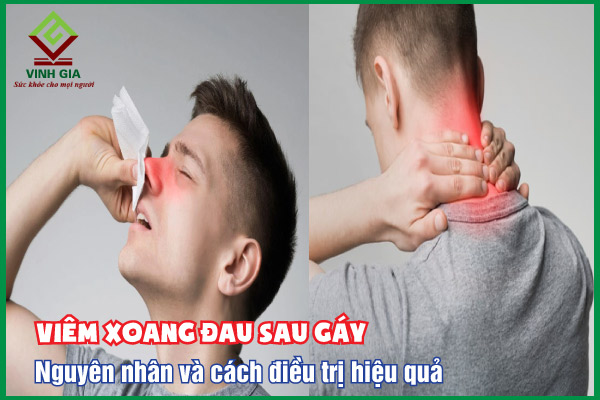 Viêm xoang đau sau gáy: Nguyên nhân và cách điều trị hiệu quả
