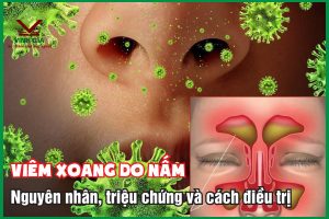 Viêm xoang do nấm: Nguyên nhân, triệu chứng và cách điều trị