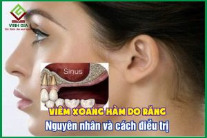 Viêm xoang hàm do răng: Nguyên nhân và phương pháp điều trị