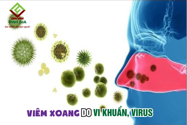 Viêm xoang mùa lạnh có thể do vi khuẩn, virus gây bệnh