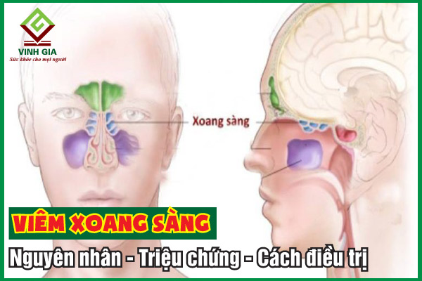 Viêm xoang sàng là gì? Nguyên nhân, triệu chứng và cách trị