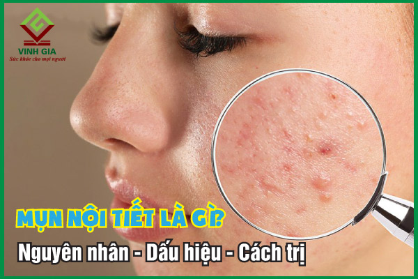 Mụn nội tiết: Nguyên nhân, dấu hiệu nhận biết và cách cải thiện