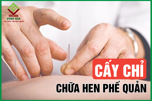 Cấy chỉ chữa hen phế quản hiệu quả không cần dùng thuốc
