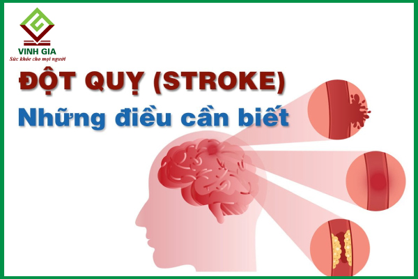 Các nguyên nhân gây đột quỵ cần biết để phòng tránh