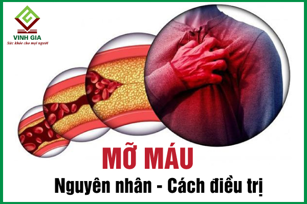 Nguyên nhân gây mỡ máu và cách cải thiện hiệu quả tại nhà