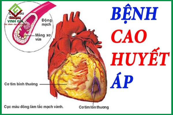 Huyết áp cao và cách phòng bệnh hiệu quả
