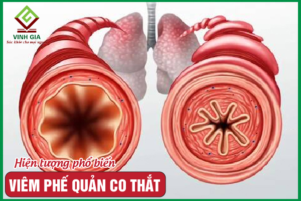 Viêm phế quản co thắt: Cách để điều trị hiệu quả